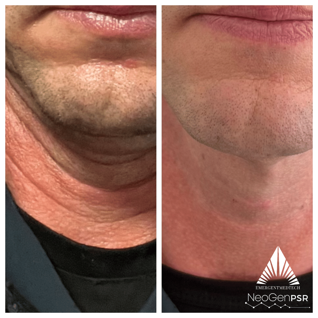 7 (Chin Neck)