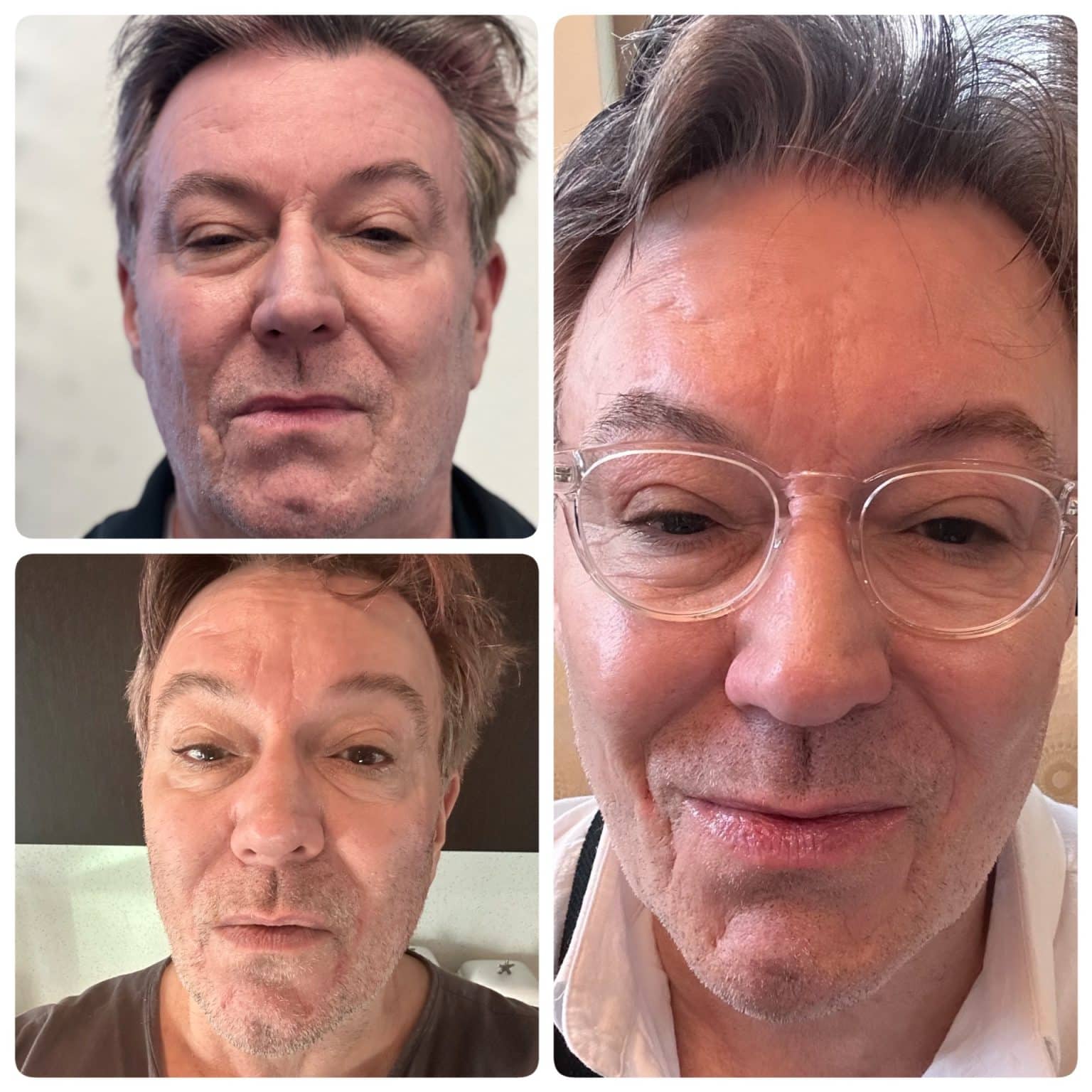 NeoGen Plasma Skin Rejuvenation Before and after.