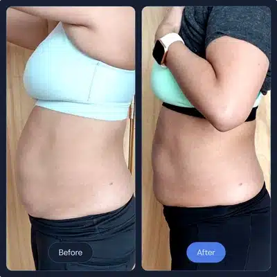 cryotherapy for body skin tightening before and after