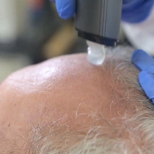 hair restoration naples - juvasonic