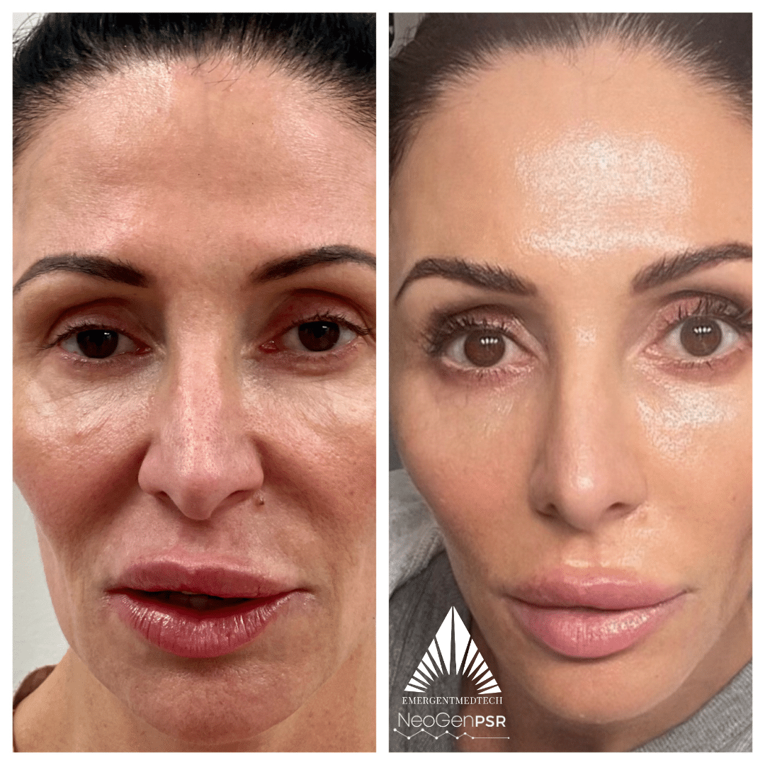 NeoGen before and after