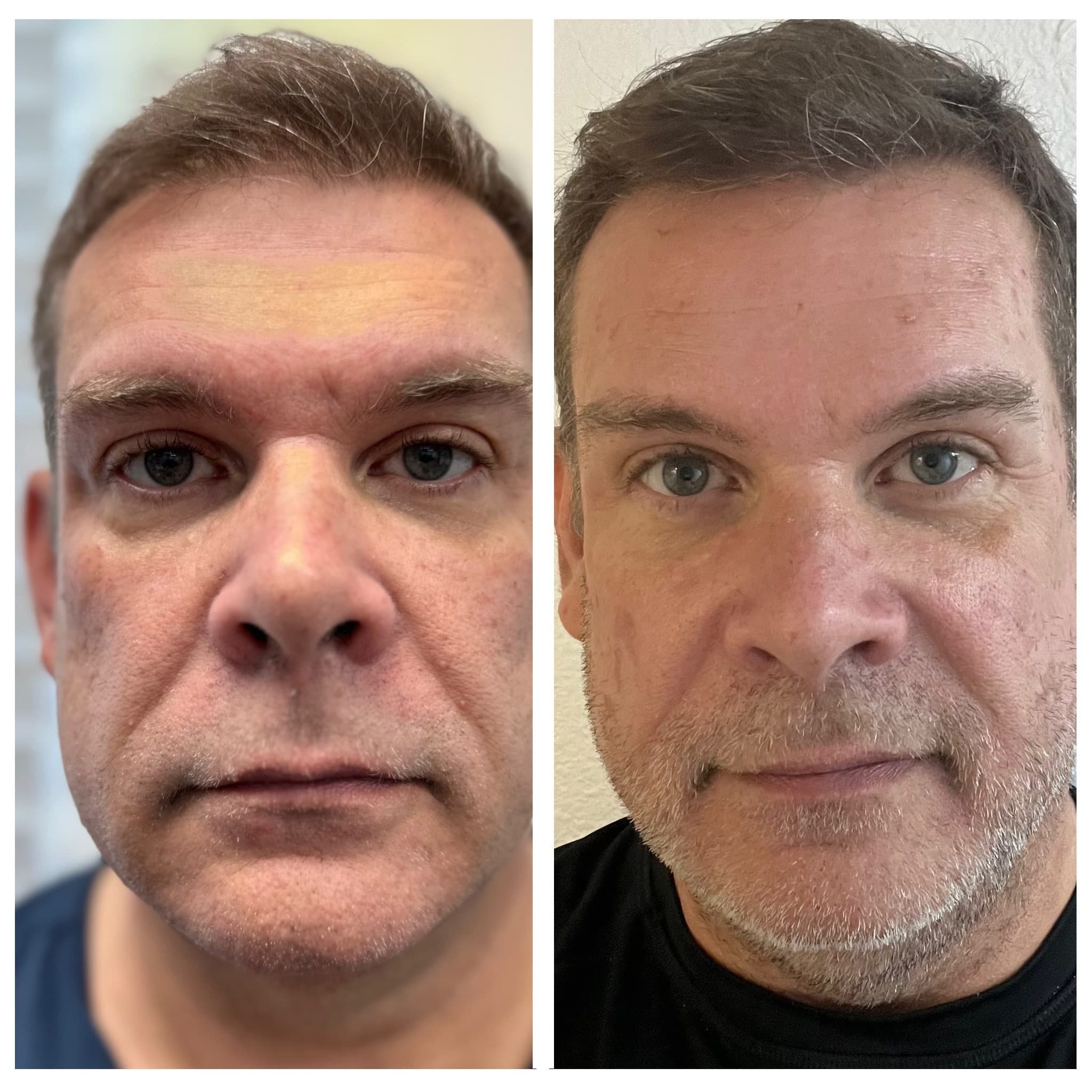 One of the first patients in the desert to receive the NeoGeon procedure