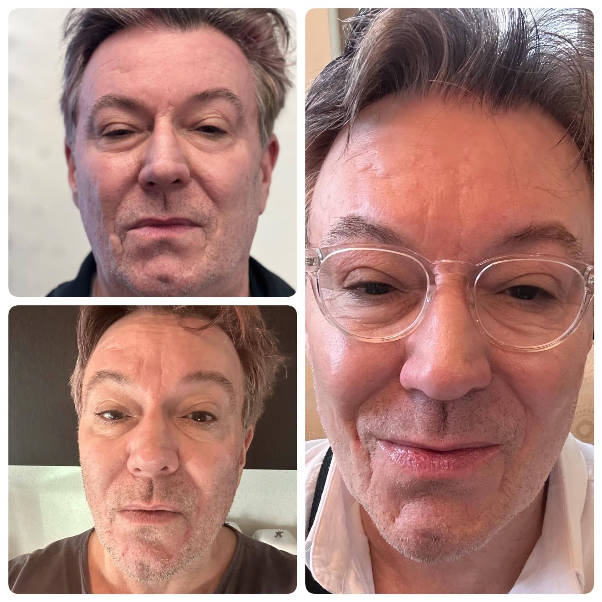 NeoGen Plasma Skin Rejuvenation Before and after.