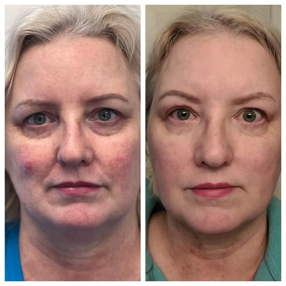 NeoGen Plasma Skin Rejuvenation Before and after.