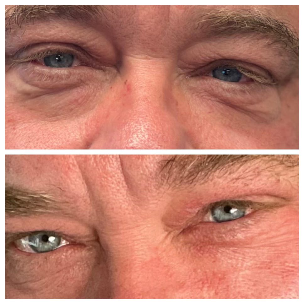 One of the first patients in the Desert to receive the NeoGen procedure.